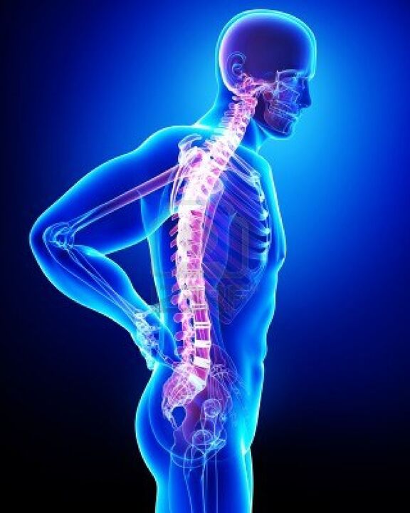 Menselijke wervelkolom aangetast door osteochondrose